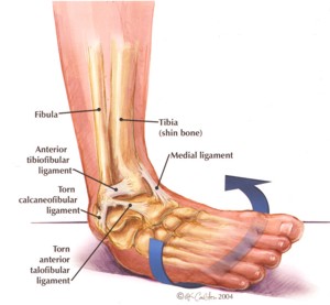 ankle-sprain